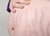 Symptome grossesse : les vergetures Symptome de grossesse