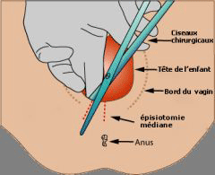 Episiotomie