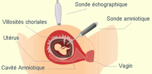 Slider Amniocentèse