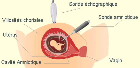 Qu’est-ce que l’amniocentèse ?