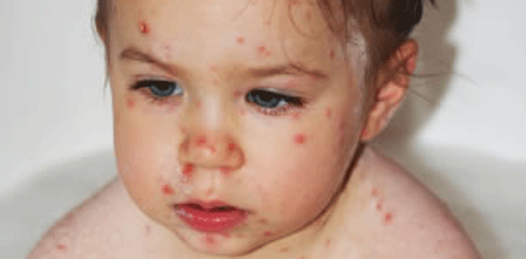La varicelle : une maladie très contagieuse
