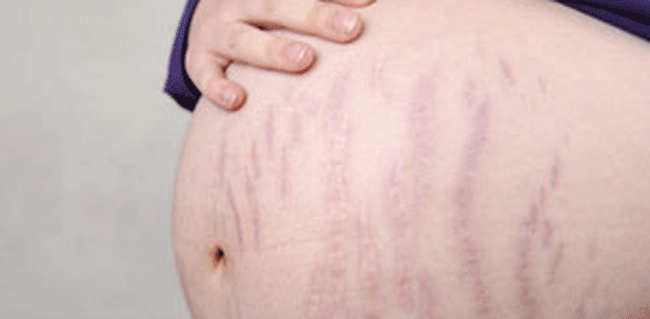 Symptome grossesse : les vergetures